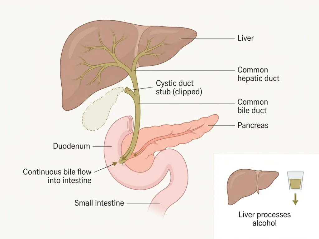 Medical illustration of the liver, bile ducts, pancreas, and small intestine after gallbladder removal